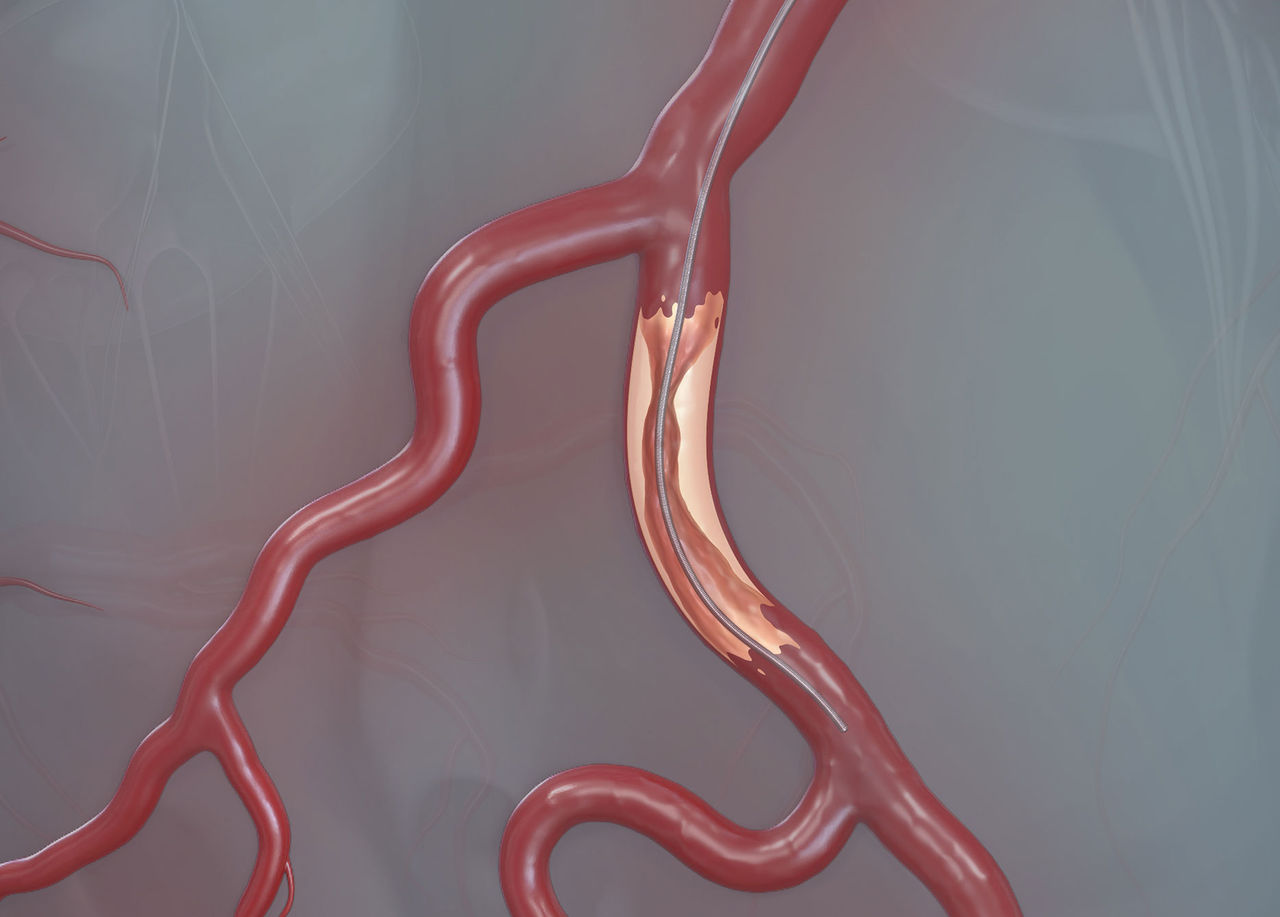Clinical application of BMW guidewire in PCI